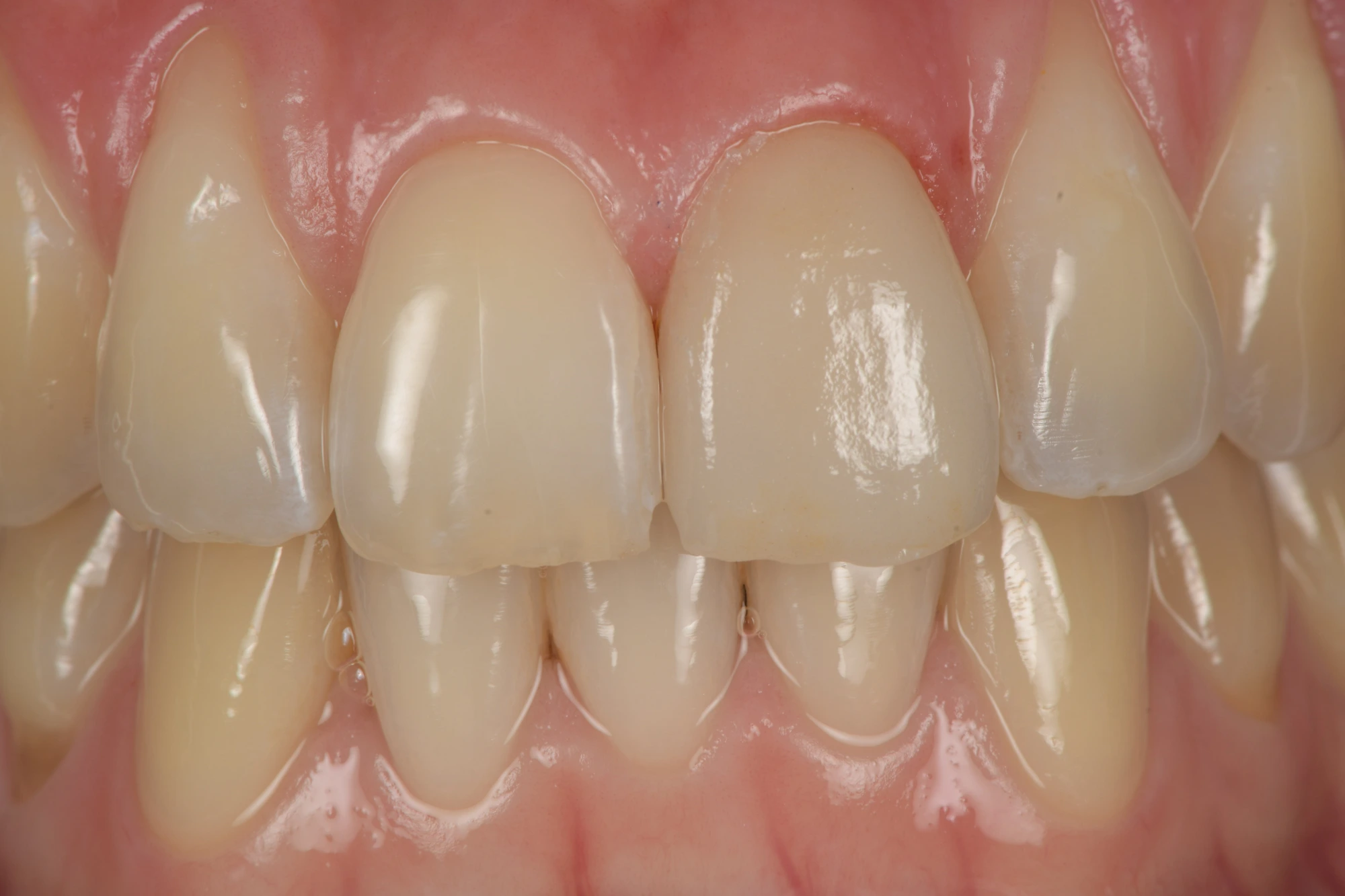 Modello dentale con caratterizzazioni cromatiche