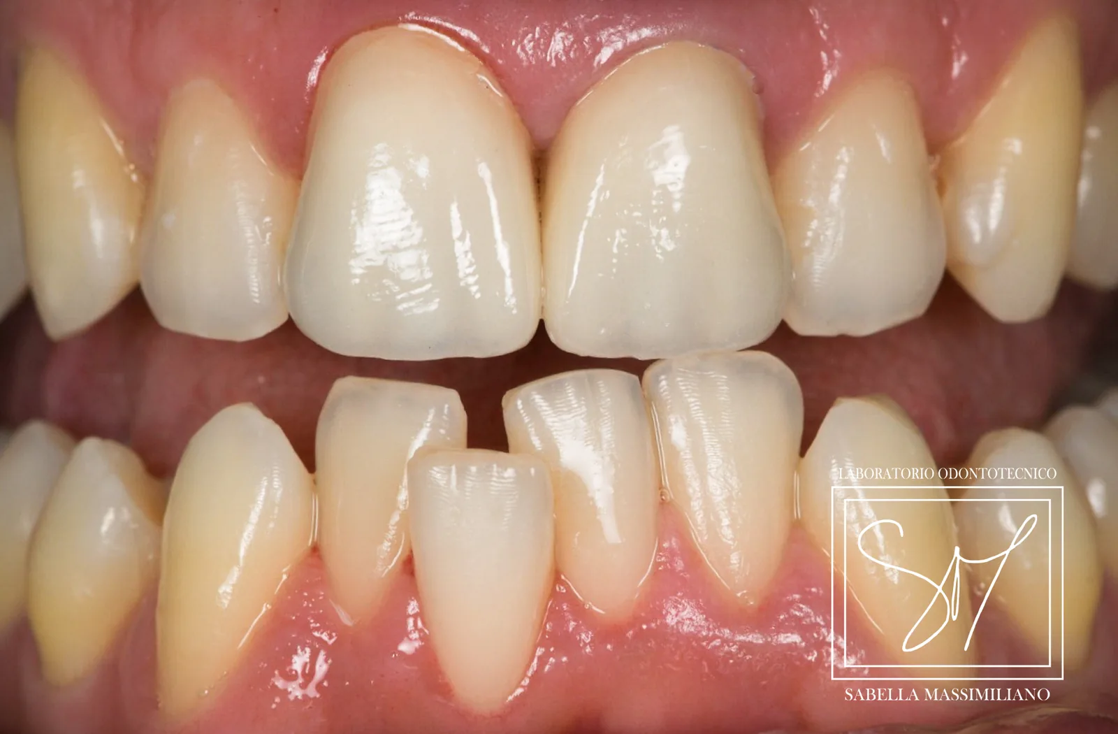 Zirconio ceramica - risultato dopo restauro estetico